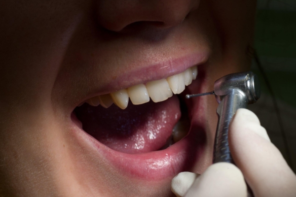 Kas hambaaukude teket on võimalik ise takistada?